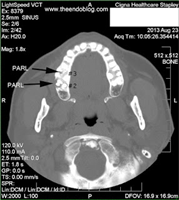 Is This Tooth Bothering My Sinus?