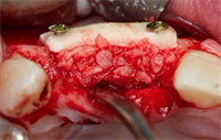 Dentaltown Learning Online- (R)Evolution of Bone Augmentation by Dr. Jan Kielhorn