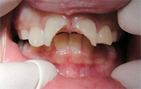 Dentaltown Learning Online- "The Blunderbuss Apex: A Search for the Smoking Gun" by Dr. Jarod Johnson