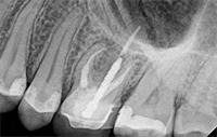 Dentaltown Learning Online....Selective Root Retreatment: A Conservative Alternative By William J. Nudera DDS, MS
