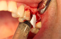 Dentaltown Learning Online...Practical Grafting Techniques for the General Practitioner By Dr. Tim Kosinski 