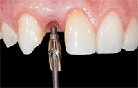 Dentaltown Learning Online... From Extraction to Prosthetic Restoration. A Comprehensive Approach. By Dr. Thanos Ntounis 