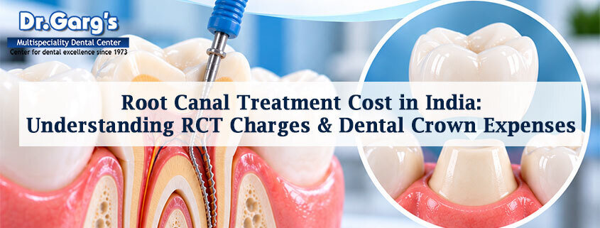 Root Canal Treatment Cost in India: Understanding RCT Charges and Dental Crown Expenses