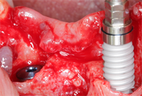 Implant Prosthodontics