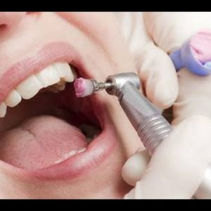 Indications and Contraindications for Coronal Polishing.