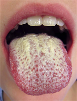 Which of the following conditions is NOT caused by a virus?