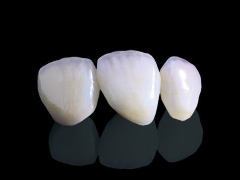 E.max Veneers vs Zirconia Veneers: Which Is Better for Front Teeth?