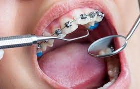 Brace Yourself: Understanding Orthodontic Treatments