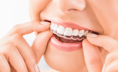 Straightening the Curve with Dental Aligners