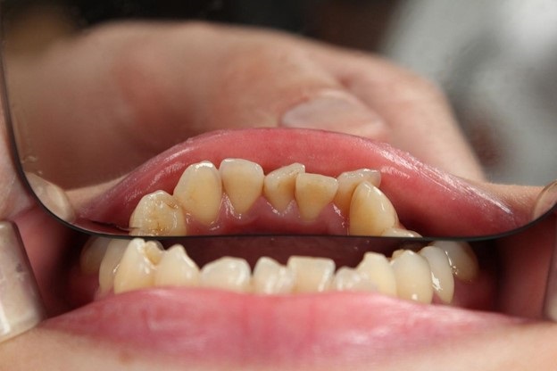 Options to Consider For Replacing a Missing Tooth
