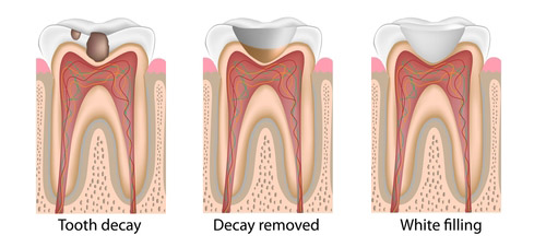 The Dangers of Tooth Fillings