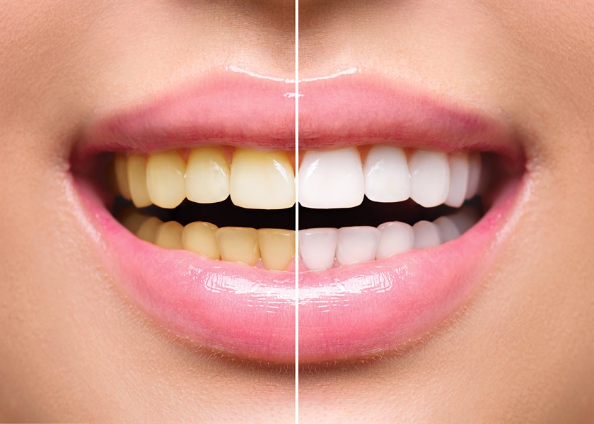 Tooth Whitening At Home