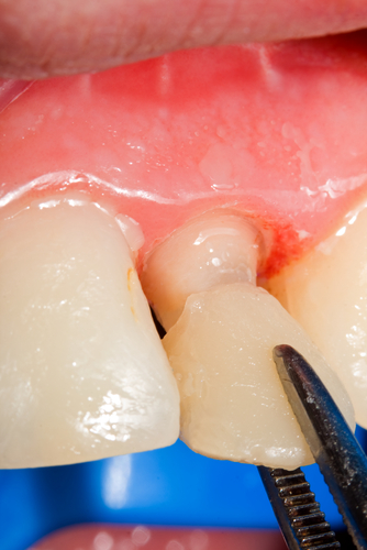 Aesthetic Crown Lengthening Part 4