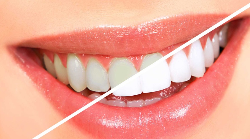 Ultimate Guide for Choosing the Best Teeth Whitening Services for You in Gilbert