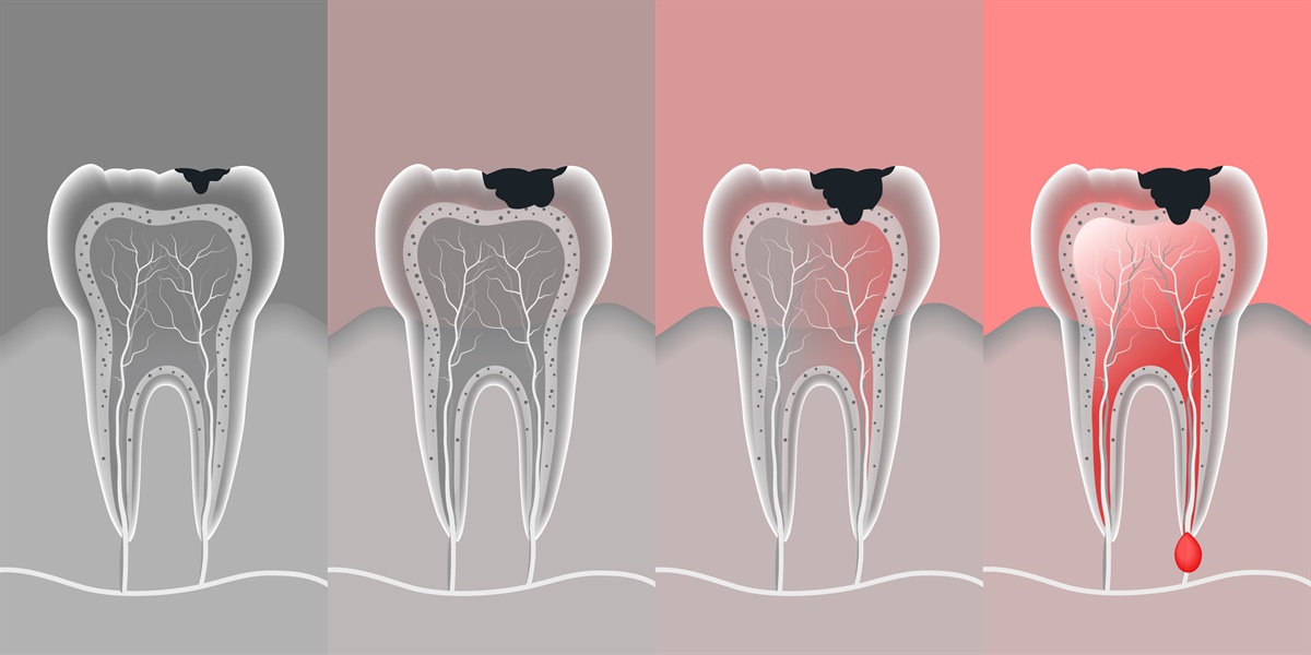 6 Myths About Cavities That Should Be Addressed ASAP