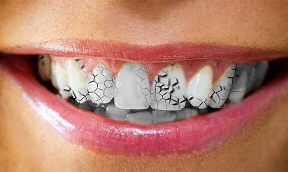 6 Things You Should Know About Craze Lines on Front Teeth