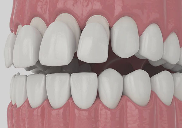 Dental Veneers