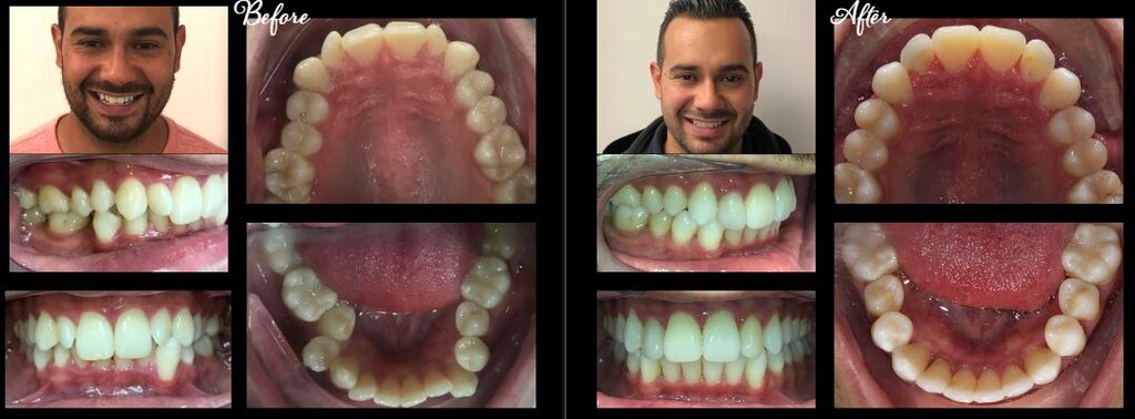 Invisalign in Stamford, CT