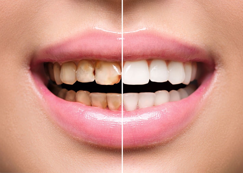 Four Good Oral Habits Everyone Should Practice