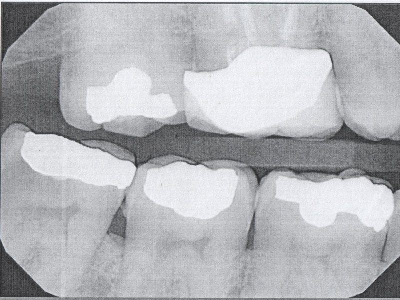 Personal Injury Claim Value for Tooth Damage