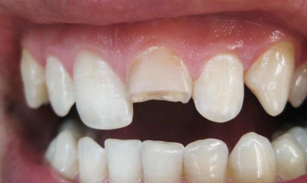 Why Minor Tooth Fractures Can Become Major Personal Injury Claims