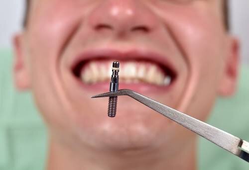 5 Important Things to Know About Age Limits for Dental Implants