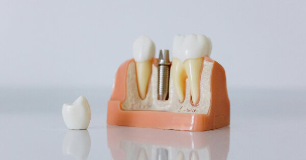 4 Important Factors That Determine If You Are a Candidate for Full Dental Implants