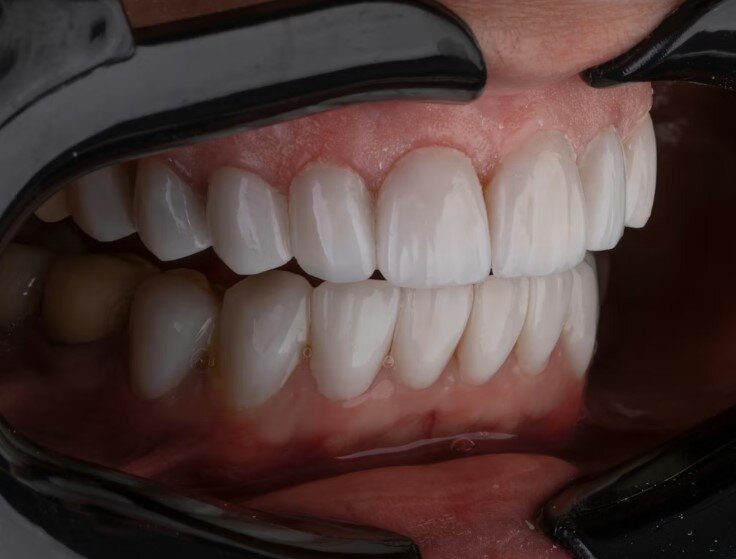 The Latest Advances in Dental Implant Technology: What Practitioners Need to Know