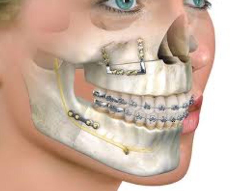 Is There an Overbite Surgery Alternative? How Non-Surgical Bite Correction Can Support Facial Balance