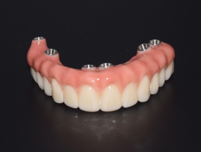 What Is the Best Dental Lab for All-on-X and Full-Arch Implant Cases? A Dentist's Guide (2026)