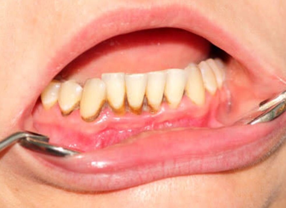 The Dental Buildout Problems That Show Up Under the Floor