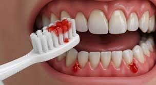 Why Do Gums Bleed When Brushing