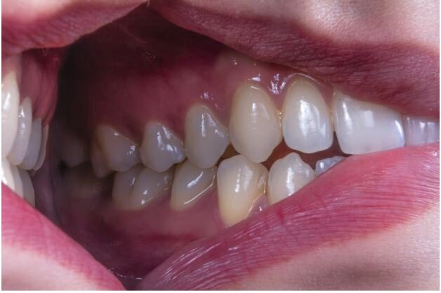 What Causes Teeth Grinding in Children and How to Manage It