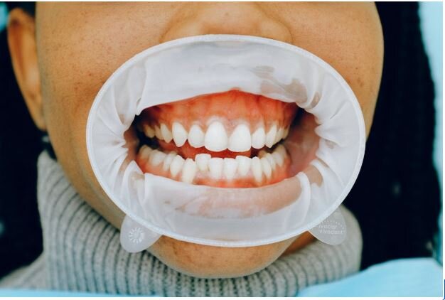 How LANAP Laser Treatment Can Improve Gum Health