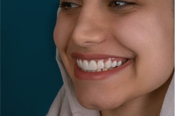 Veneers for Enhanced Smiles: Exploring Instant Smile Makeovers