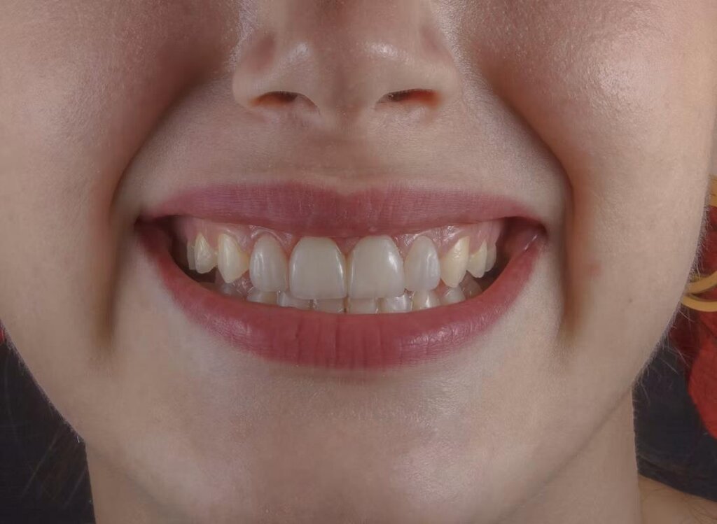 Veneers vs. Dental Bonding: Which Cosmetic Option Is Right for You?