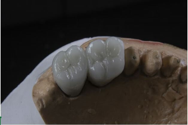 Comparing Different Types of Dental Implants