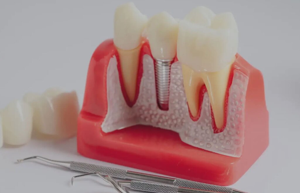Dental Implants: A Practical Guide to Replacing Missing Teeth
