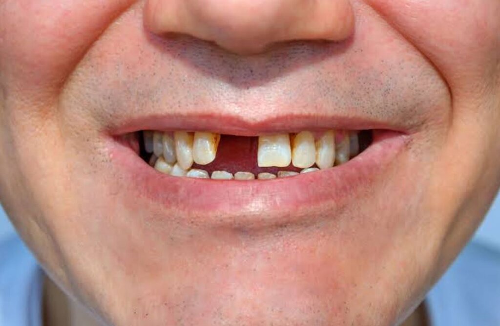 Missing a Tooth? Here's What You Should Know About Dental Implants