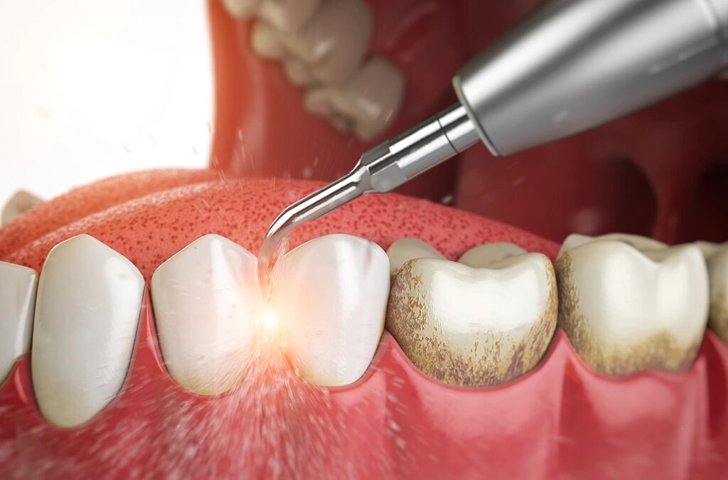 Teeth Plaque Remover: A Simple Step toward a Healthier Smile 