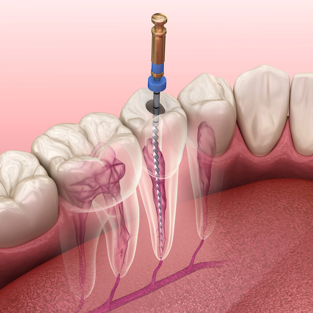 Understanding Root Canal Treatment: When You Need an Endodontist