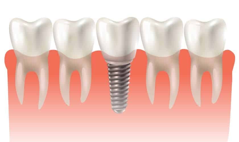 Dental Implants: A Long-Term Solution for Missing Teeth