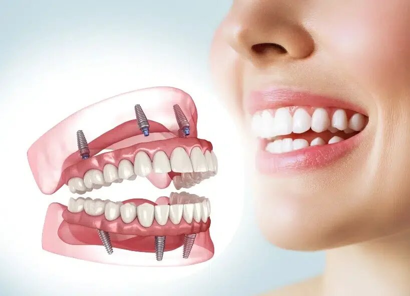 All-on-4 Dental Implants in Turkey: Costs, Benefits, and Treatment Process