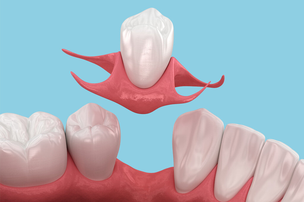 Missing a Tooth? Here's What Nobody Tells You Before Getting a Dental Implant