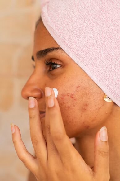 Stopping Breakouts in Their Tracks: PanOxyl Acne Clearing Spot Treatment